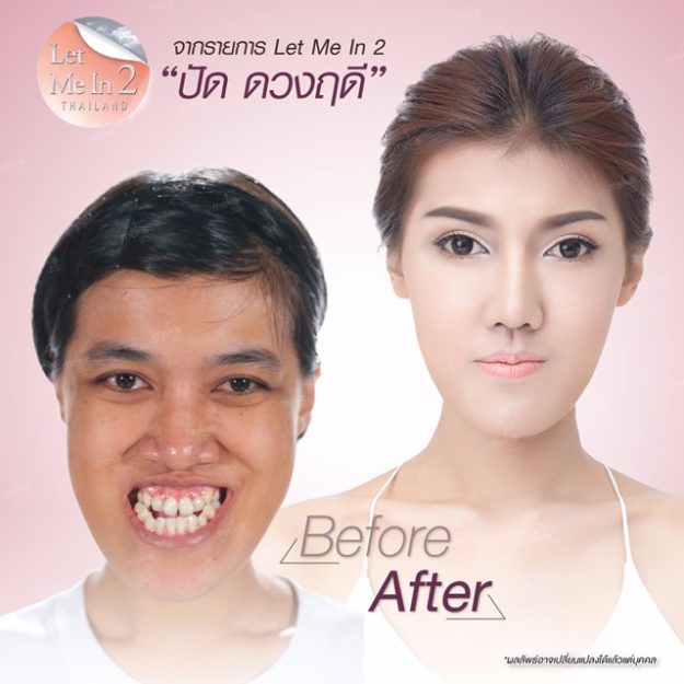 ศัลยกรรมเปลี่ยนหน้า…ท้าชีวิตอาภัพ “ปัด” Let Me In Thailand 2